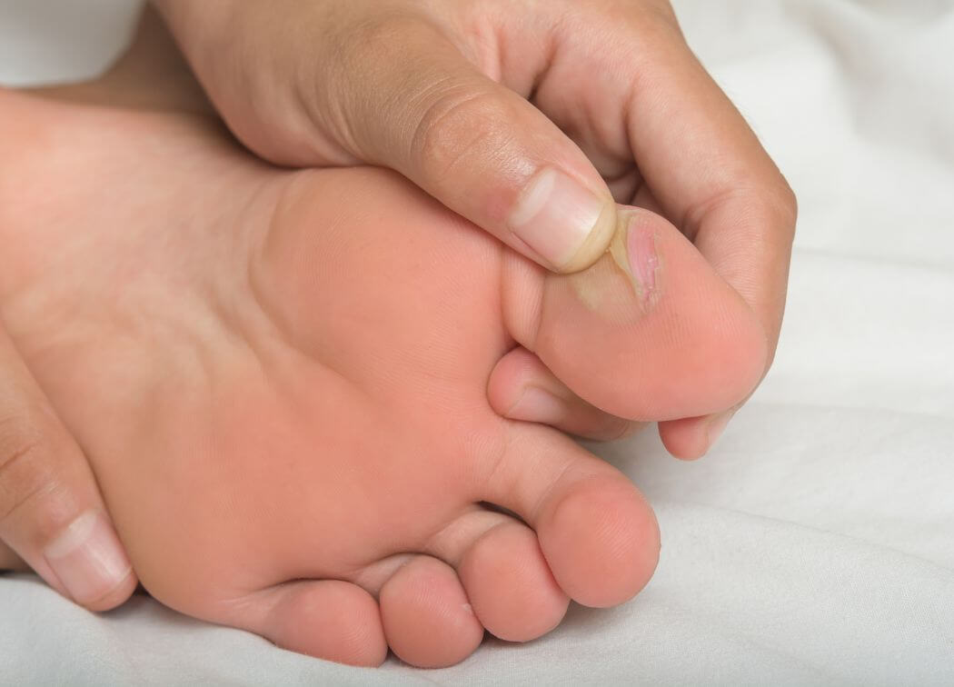 How to Prevent Blisters on Feet